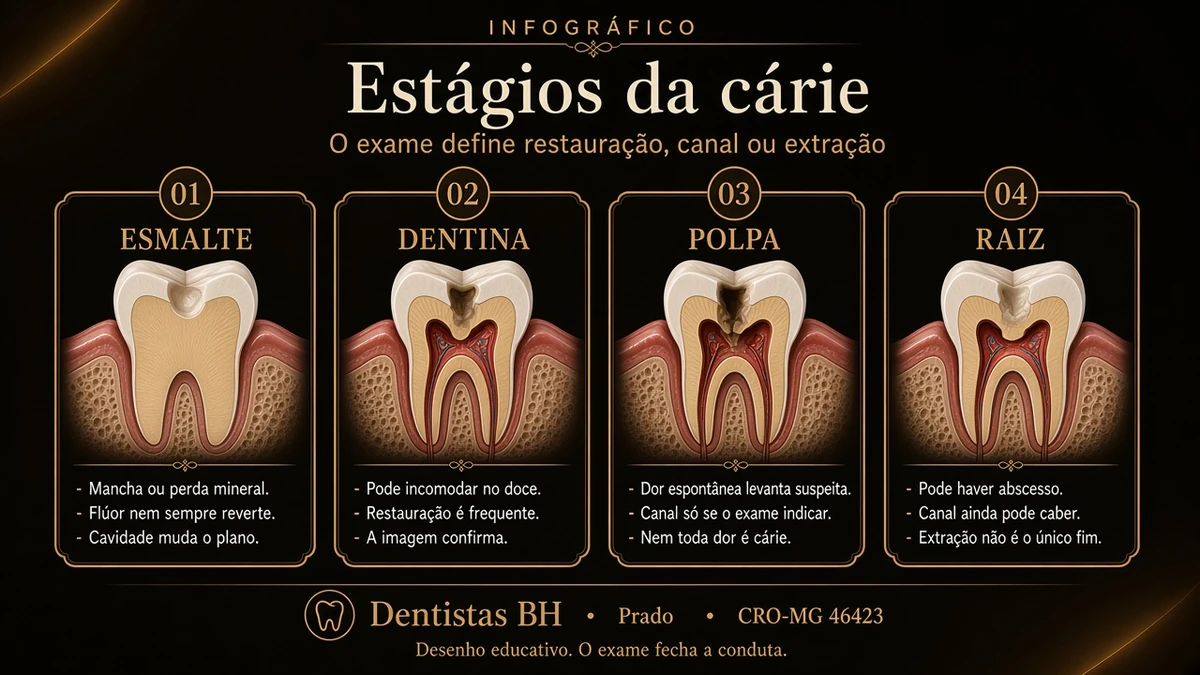 Desenho dos estágios da cárie: esmalte, dentina, polpa e raiz, sem preços, com a ressalva de que o exame define restauração, canal ou extração, Dentistas BH, Prado