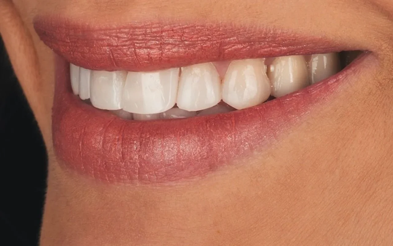 Prótese fixa sobre implante após osseointegração no Prado, Belo Horizonte — Dentistas BH