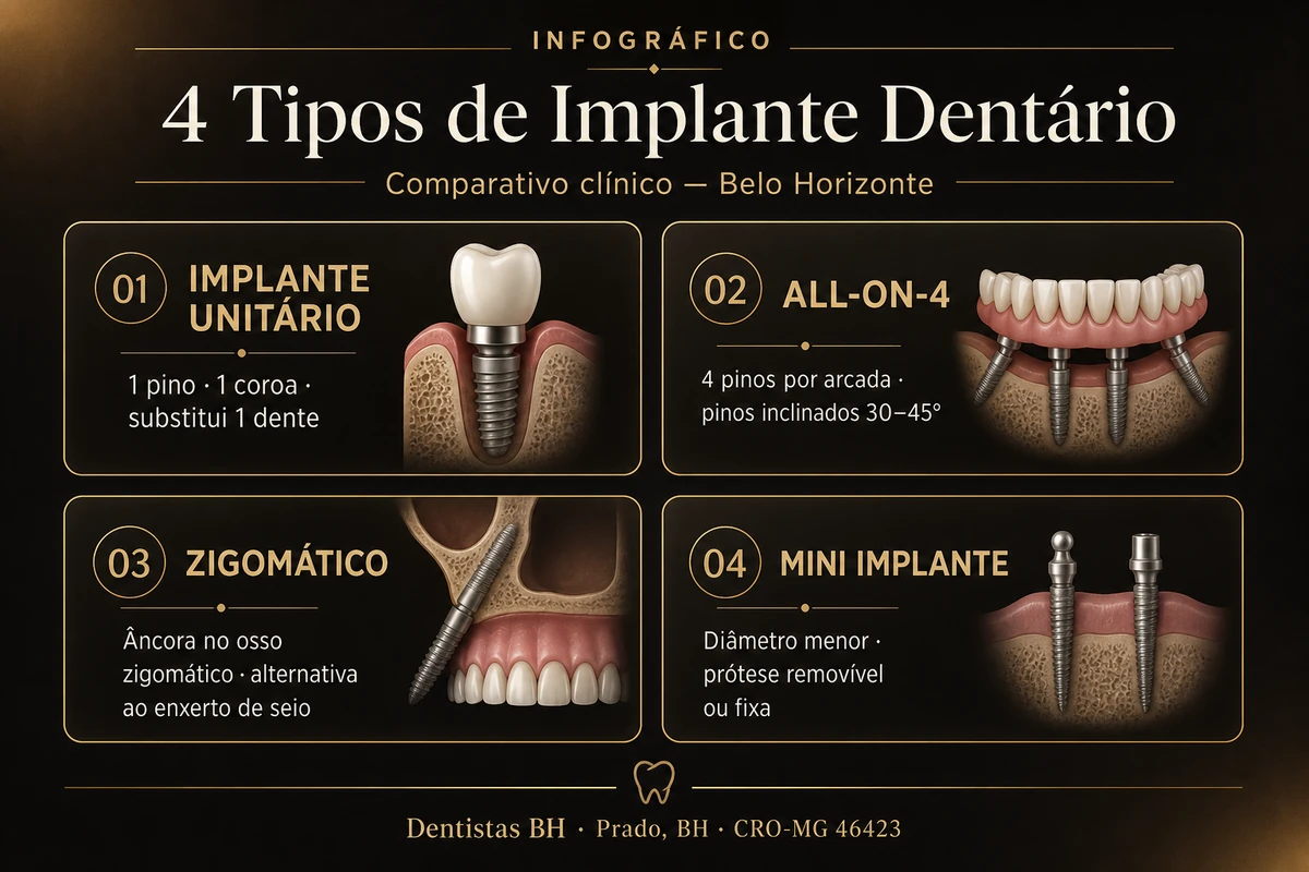 Infográfico comparativo dos tipos de implante dentário em Belo Horizonte — unitário, All-on-4, zigomático e mini