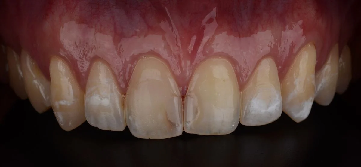 Registro clínico antes de facetas ou lentes — consultório no Prado, BH