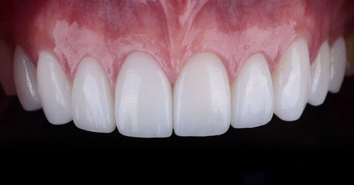 Registro clínico após reabilitação estética — Prado, Belo Horizonte