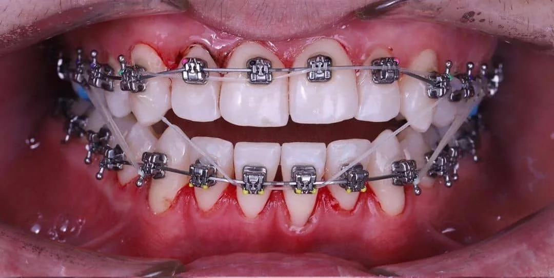 Registro clínico antes do tratamento ortodôntico — Dentistas BH, Prado