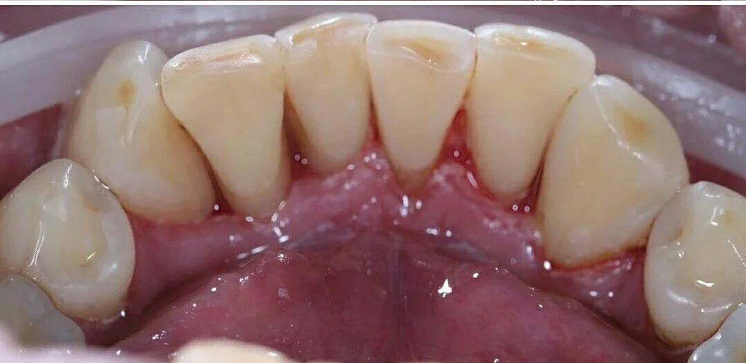 Depois — dentes limpos