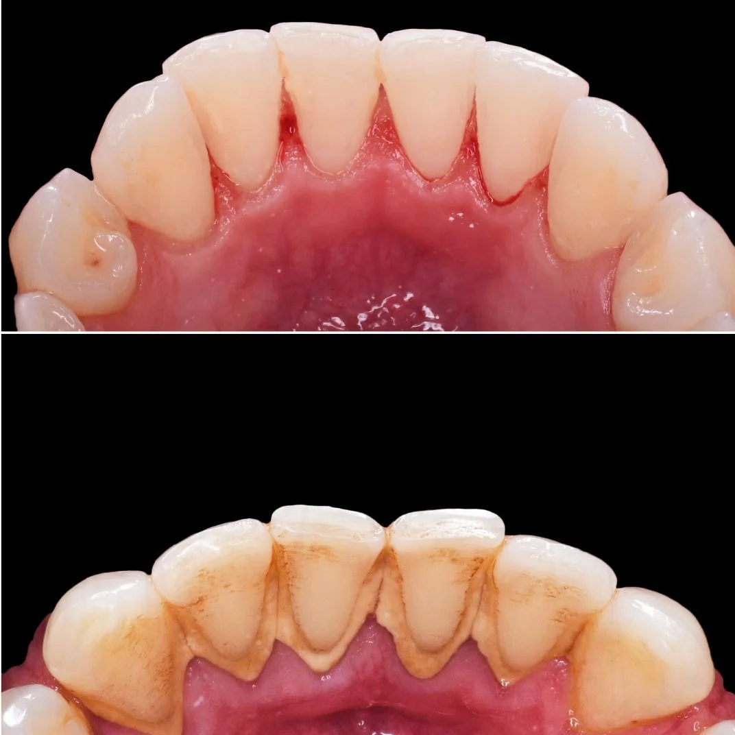 Registro clínico após limpeza dental (profilaxia) — consultório Dentistas BH, Prado