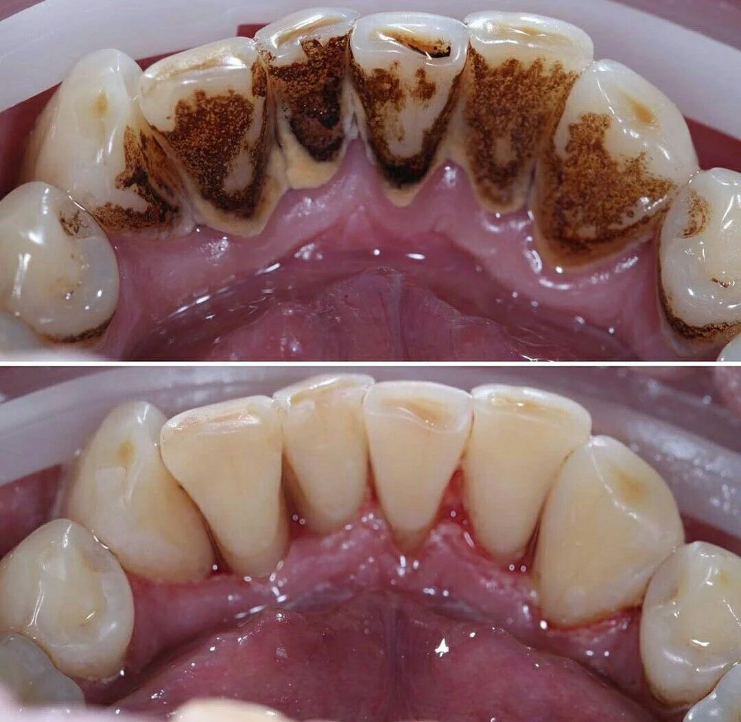Registro clínico antes da profilaxia — acúmulo de biofilme e tártaro, Prado, BH