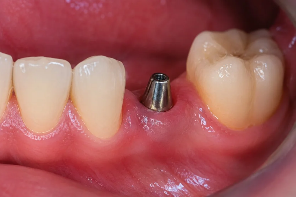 Procedimento de implante dentário no consultório Dentistas BH, Prado, Belo Horizonte